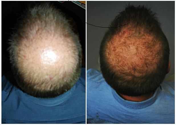 Hair Loss Alopecia Or Thinning Hair Has An Effective Natural Solution